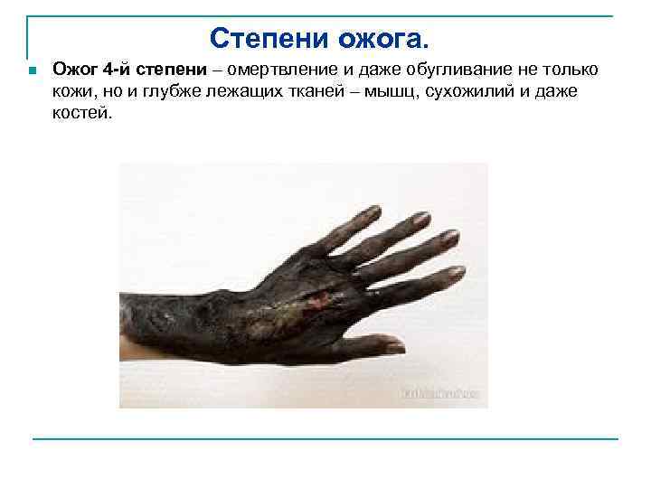 Степени ожога. n Ожог 4 -й степени – омертвление и даже обугливание не только