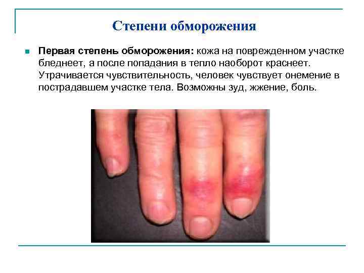 Степени обморожения n Первая степень обморожения: кожа на поврежденном участке бледнеет, а после попадания