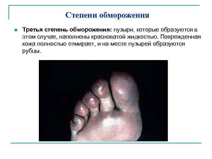 Степени обморожения n Третья степень обморожения: пузыри, которые образуются в этом случае, наполнены красноватой