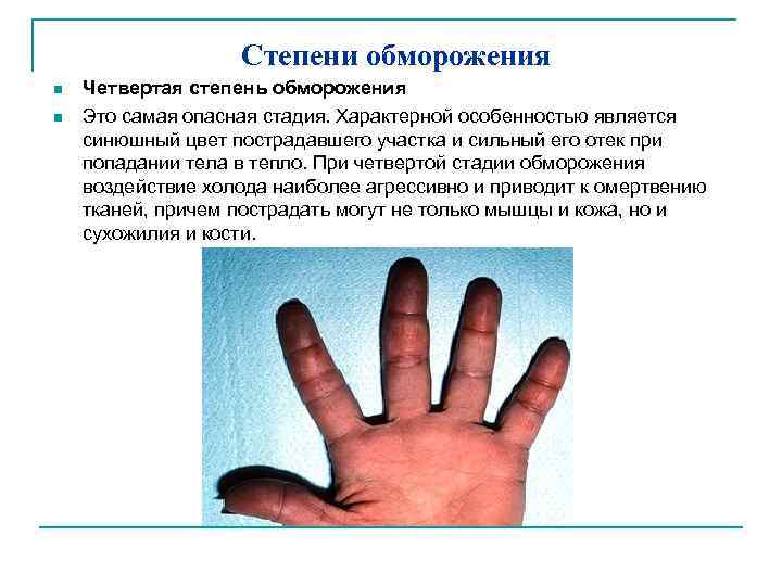Степени обморожения n n Четвертая степень обморожения Это самая опасная стадия. Характерной особенностью является