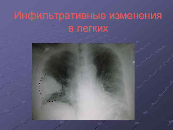Инфильтративные изменения в легких 