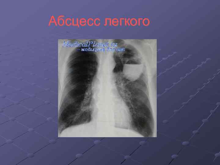 Абсцесс легкого 