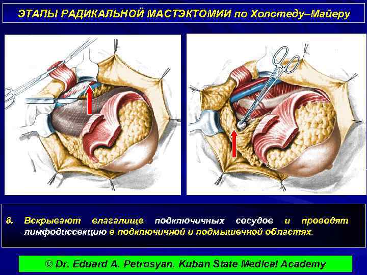 ЭТАПЫ РАДИКАЛЬНОЙ МАСТЭКТОМИИ по Холстеду–Майеру 8. Вскрывают влагалище подключичных сосудов и проводят лимфодиссекцию в