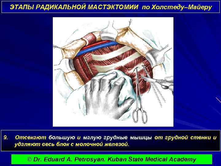 ЭТАПЫ РАДИКАЛЬНОЙ МАСТЭКТОМИИ по Холстеду–Майеру 9. Отсекают большую и малую грудные мышцы от грудной
