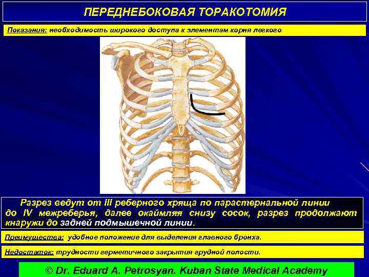 ПЕРЕДНЕБОКОВАЯ ТОРАКОТОМИЯ Показания: необходимость широкого доступа к элементам корня легкого Разрез ведут от III