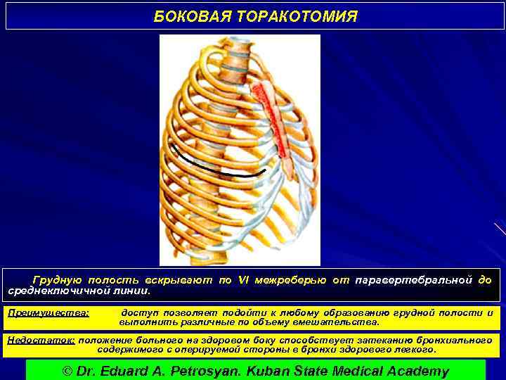 БОКОВАЯ ТОРАКОТОМИЯ Грудную полость вскрывают по VI межреберью от паравертебральной до среднеключичной линии. Преимущества: