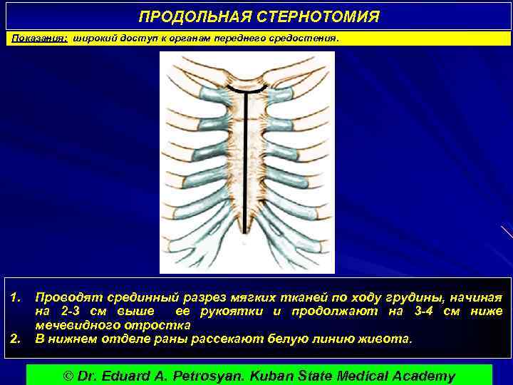 ПРОДОЛЬНАЯ СТЕРНОТОМИЯ Показания: широкий доступ к органам переднего средостения. 1. 2. Проводят срединный разрез