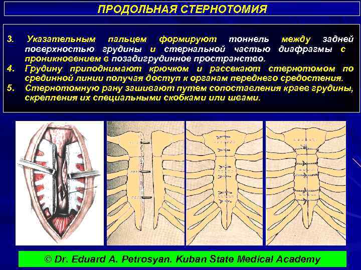 ПРОДОЛЬНАЯ СТЕРНОТОМИЯ 3. 4. 5. Указательным пальцем формируют тоннель между задней поверхностью грудины и