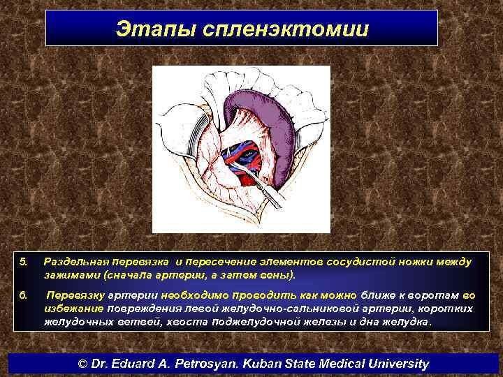 Этапы спленэктомии 5. Раздельная перевязка и пересечение элементов сосудистой ножки между зажимами (сначала артерии,