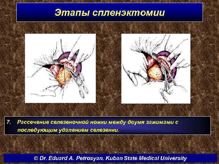 Этапы спленэктомии 7. Рассечение селезеночной ножки между двумя зажимами с последующим удалением селезенки. ©