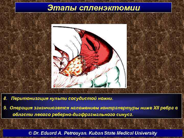 Этапы спленэктомии 8. Перитонизация культи сосудистой ножки. 9. Операция заканчивается наложением контрапертуры ниже XII