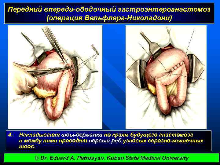 Передний впереди-ободочный гастроэнтероанастомоз (операция Вельфлера-Николадони) 4. Накладывают швы-держалки по краям будущего анастомоза и между
