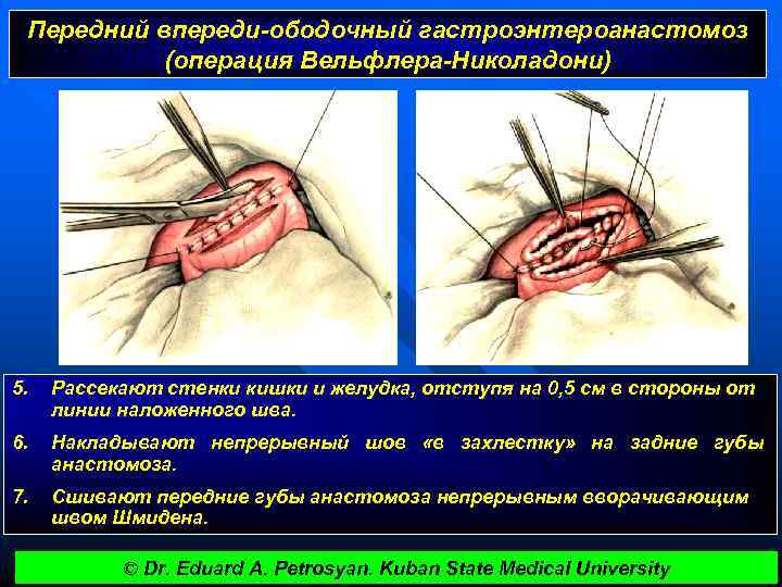 Передний впереди-ободочный гастроэнтероанастомоз (операция Вельфлера-Николадони) 5. Рассекают стенки кишки и желудка, отступя на 0,