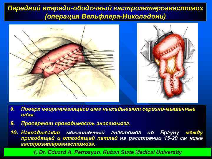 Передний впереди-ободочный гастроэнтероанастомоз (операция Вельфлера-Николадони) 8. Поверх вворачивающего шва накладывают серозно-мышечные швы. 9. Проверяют