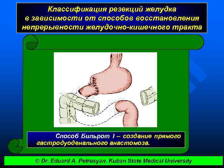 Классификация резекций желудка в зависимости от способов восстановления непрерывности желудочно-кишечного тракта Способ Бильрот I