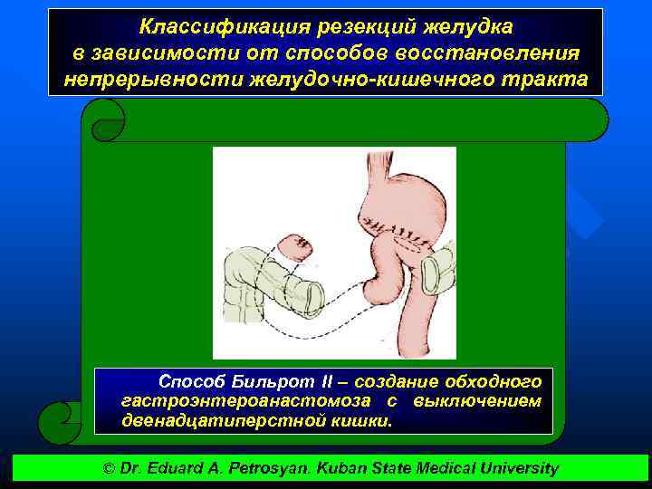 Результаты после резекции желудка фото