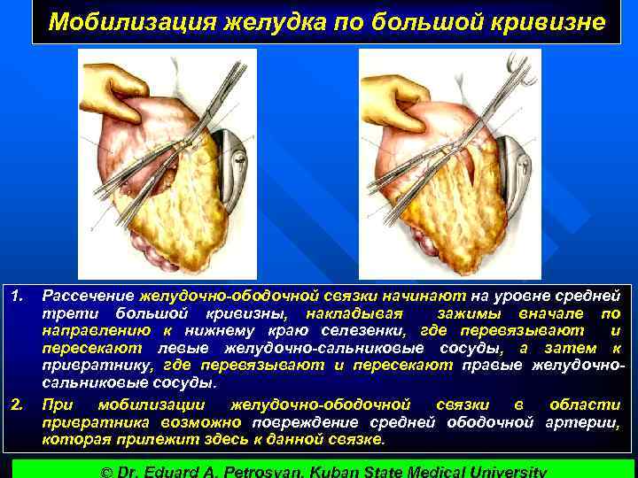 Мобилизация желудка по большой кривизне 1. 2. Рассечение желудочно-ободочной связки начинают на уровне средней