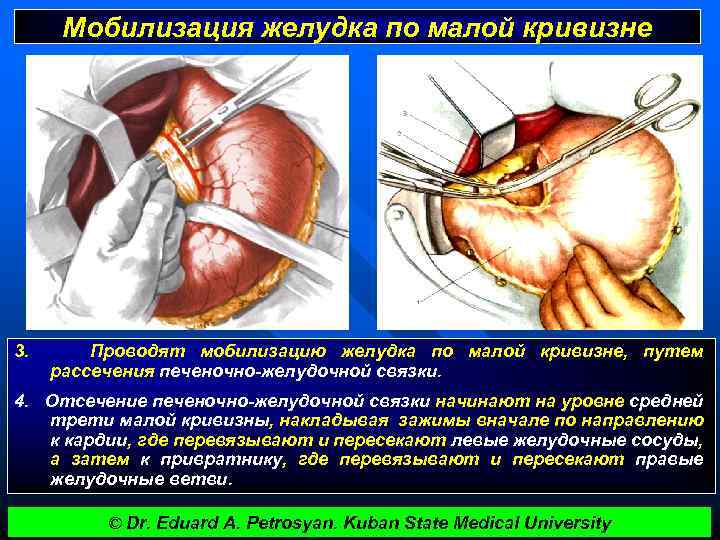 Мобилизация желудка по малой кривизне 3. Проводят мобилизацию желудка по малой кривизне, путем рассечения