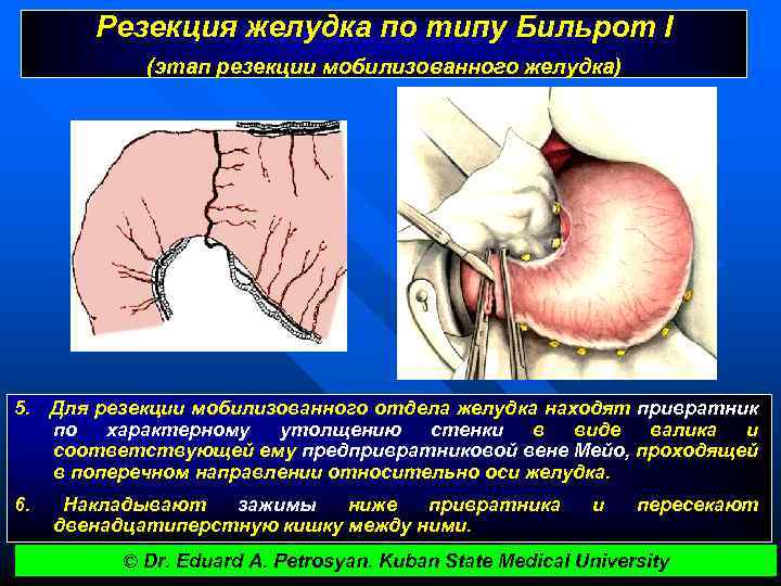 Резекция желудка по типу Бильрот I (этап резекции мобилизованного желудка) 5. Для резекции мобилизованного