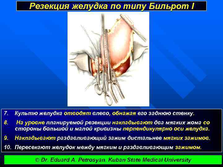 Резекция желудка по типу Бильрот I 7. Культю желудка отводят влево, обнажая его заднюю