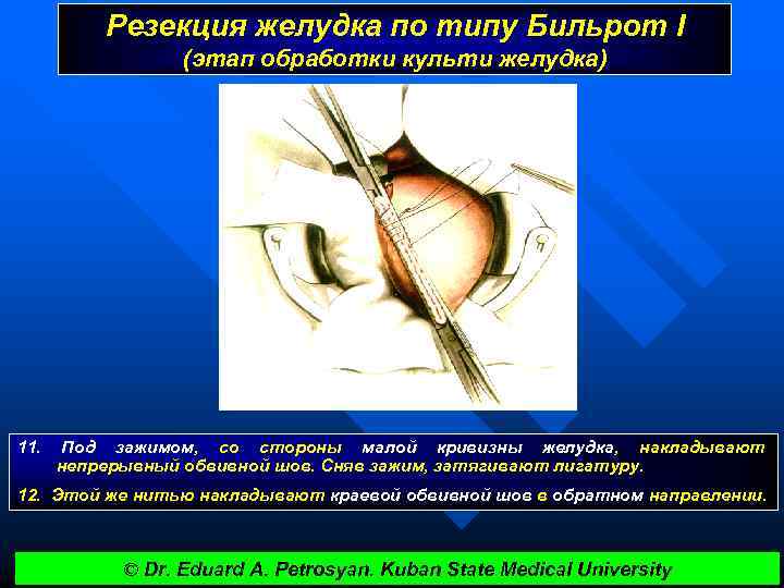 Резекция желудка по типу Бильрот I (этап обработки культи желудка) 11. Под зажимом, со