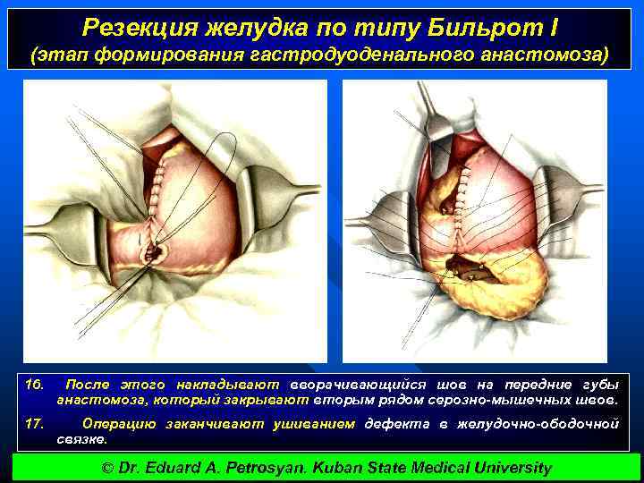Резекция желудка по типу Бильрот I (этап формирования гастродуоденального анастомоза) 16. После этого накладывают