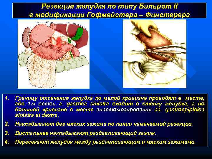 Бильрот 2 схема