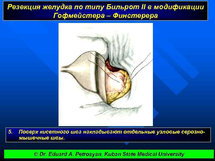 Резекция желудка по типу Бильрот II в модификации Гофмейстера – Финстерера 5. Поверх кисетного