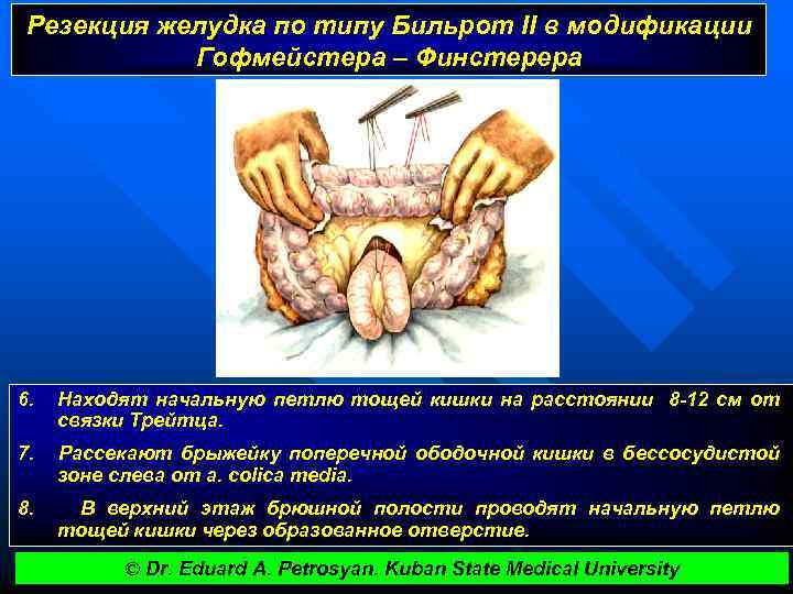 Резекция желудка по типу Бильрот II в модификации Гофмейстера – Финстерера 6. Находят начальную