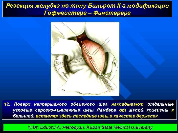 Резекция желудка схема