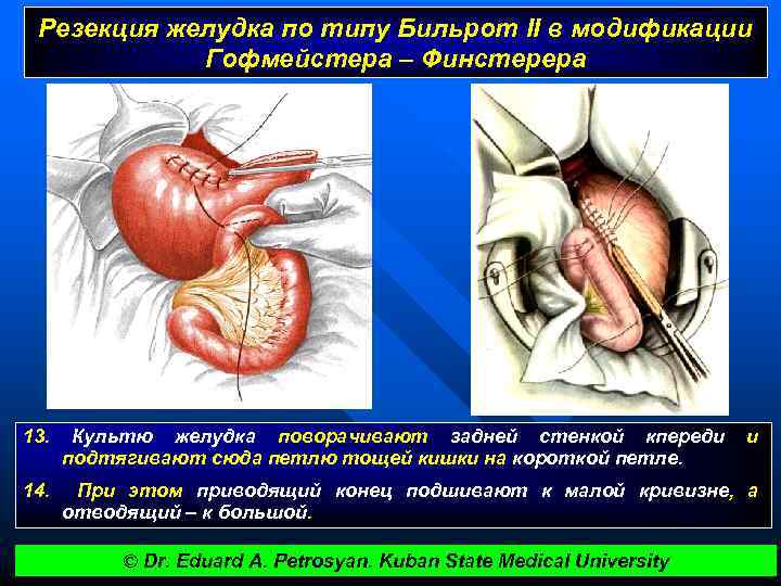 Резекция желудка по типу Бильрот II в модификации Гофмейстера – Финстерера 13. Культю желудка