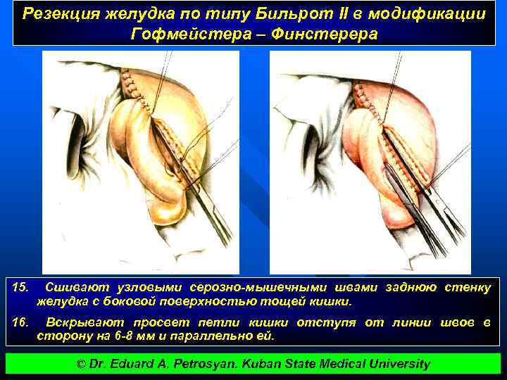 Резекция желудка по типу Бильрот II в модификации Гофмейстера – Финстерера 15. Сшивают узловыми