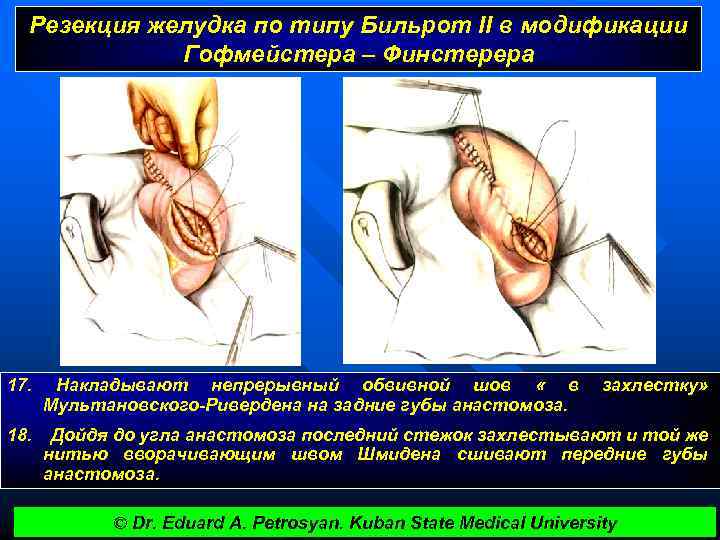 Резекция желудка по типу Бильрот II в модификации Гофмейстера – Финстерера 17. Накладывают непрерывный