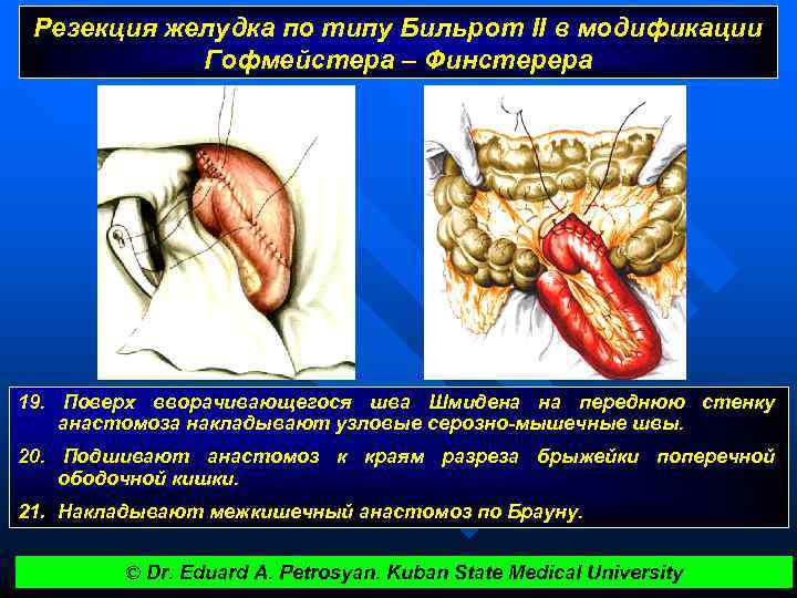 Резекция желудка по типу Бильрот II в модификации Гофмейстера – Финстерера 19. Поверх вворачивающегося