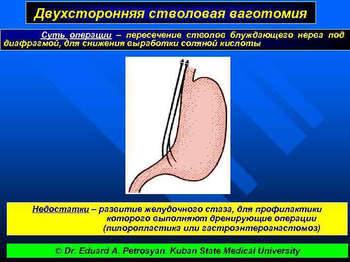 Двухсторонняя стволовая ваготомия Суть операции – пересечение стволов блуждающего нерва под диафрагмой, для снижения