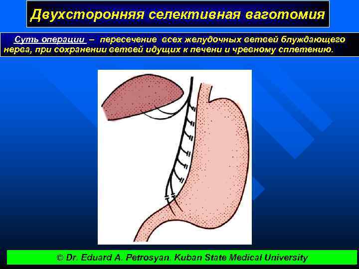 Двухсторонняя селективная ваготомия Суть операции – пересечение всех желудочных ветвей блуждающего нерва, при сохранении