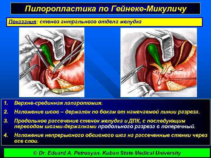Пилоропластика по Гейнеке-Микуличу Показания: стеноз антрального отдела желудка 1. Верхне-срединная лапаротомия. 2. Наложение швов