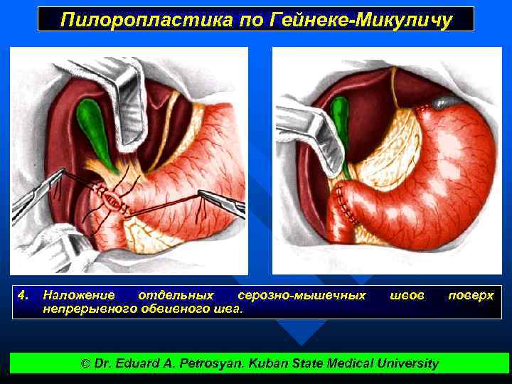 Пилоропластика по Гейнеке-Микуличу 4. Наложение отдельных серозно-мышечных непрерывного обвивного шва. швов © Dr. Eduard