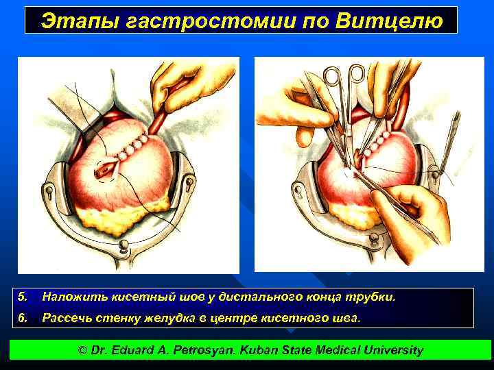 Этапы гастростомии по Витцелю 5. Наложить кисетный шов у дистального конца трубки. 6. Рассечь