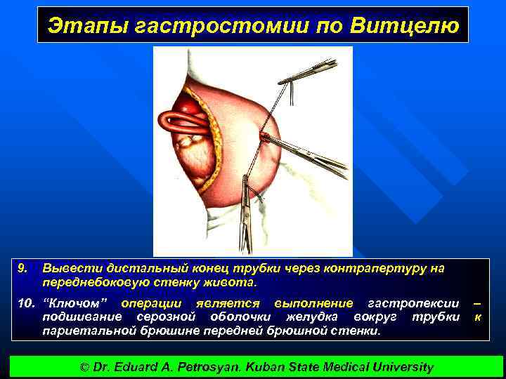 Этапы гастростомии по Витцелю 9. Вывести дистальный конец трубки через контрапертуру на переднебоковую стенку