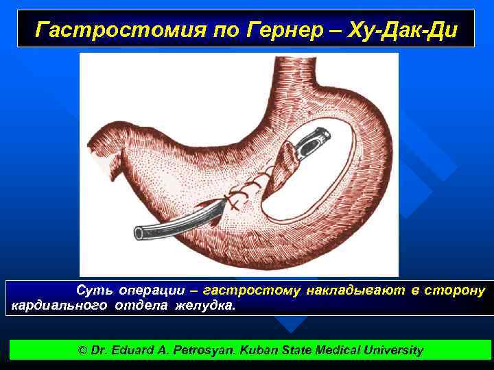 Прободная язва желудка карта вызова