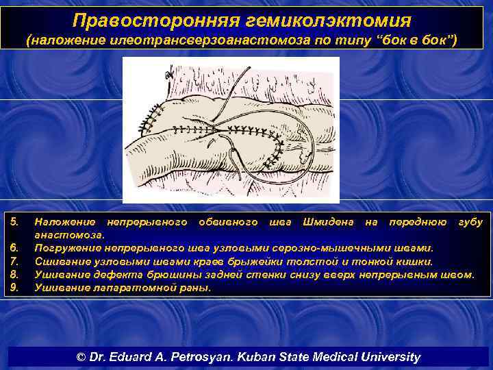 Правосторонняя гемиколэктомия (наложение илеотрансверзоанастомоза по типу “бок в бок”) 5. 6. 7. 8. 9.