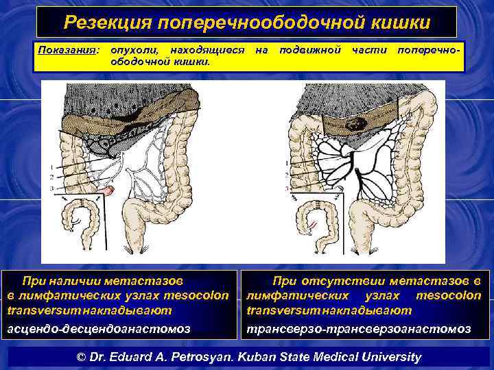 Резекция поперечноободочной кишки Показания: опухоли, находящиеся на подвижной части поперечноободочной кишки. При наличии метастазов