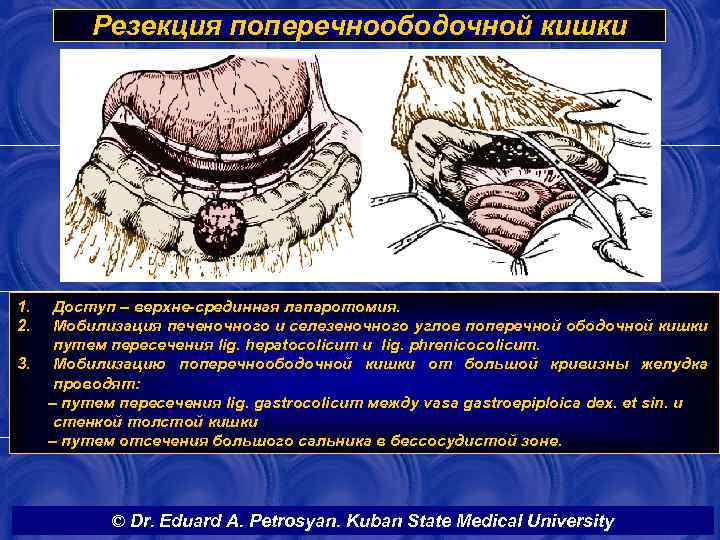 Резекция поперечноободочной кишки 1. 2. 3. Доступ – верхне-срединная лапаротомия. Мобилизация печеночного и селезеночного