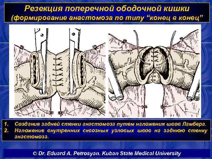 Резекция поперечной ободочной кишки (формирование анастомоза по типу “конец в конец” 1. 2. Создание