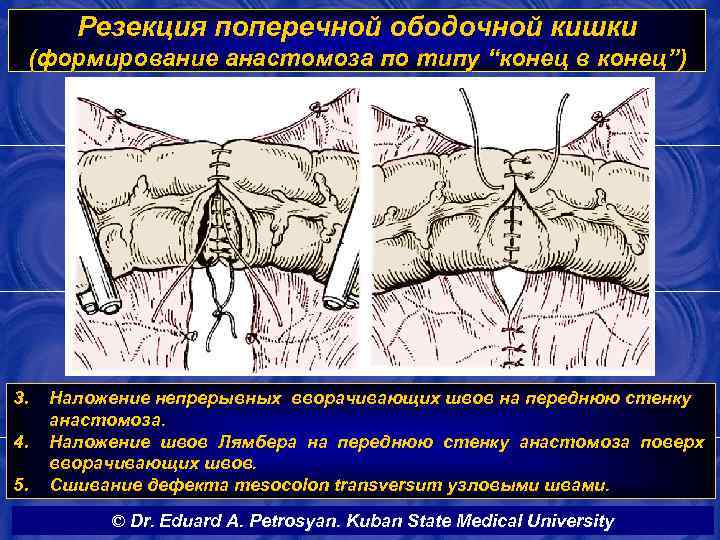 Резекция поперечной ободочной кишки (формирование анастомоза по типу “конец в конец”) 3. 4. 5.