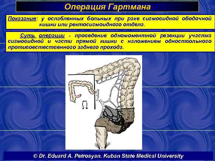 Операция Гартмана Показания: у ослабленных больных при раке сигмовидной ободочной кишки или ректосигмоидного отдела.