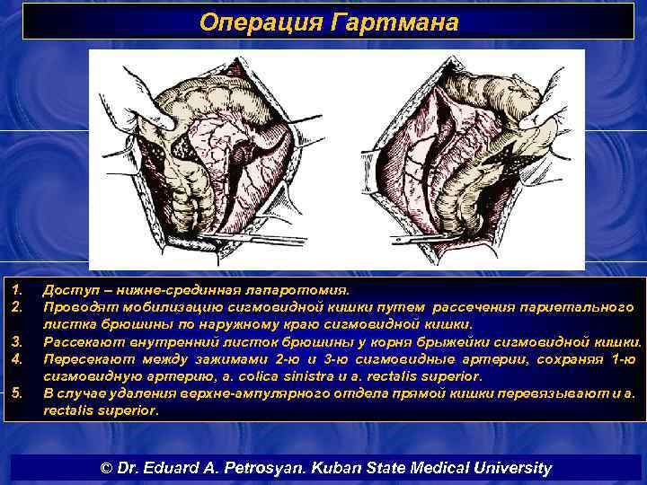 Операция Гартмана 1. 2. 3. 4. 5. Доступ – нижне-срединная лапаротомия. Проводят мобилизацию сигмовидной