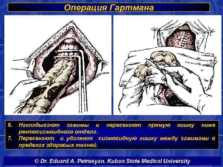 Операция Гартмана 6. 7. Накладывают зажимы и пересекают прямую кишку ниже ректосигмоидного отдела. Пересекают