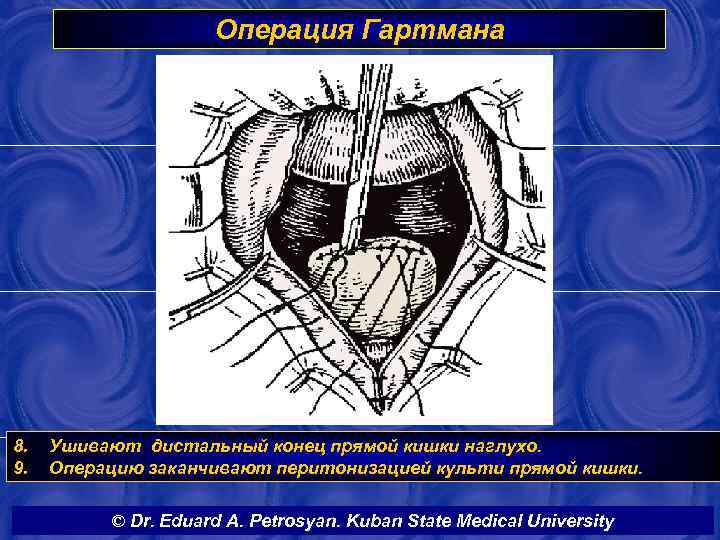 Операция Гартмана 8. 9. Ушивают дистальный конец прямой кишки наглухо. Операцию заканчивают перитонизацией культи